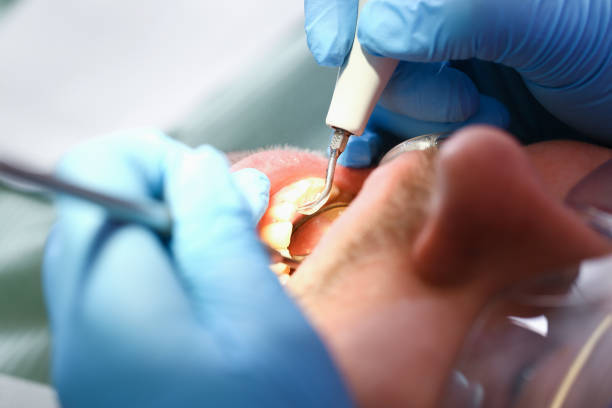 Best Emergency Root Canal Treatment in St Louis, MI
