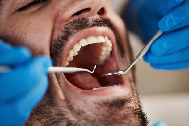 Best Emergency Dental Extractions in St Louis, MI